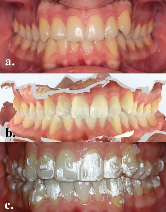 Ortodontide Şeffaf Plak Tedavileri-3.jpg