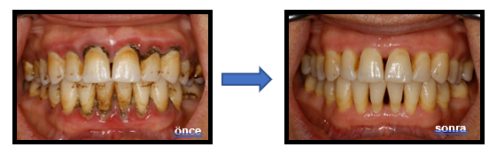 periodontal-tedavi.png